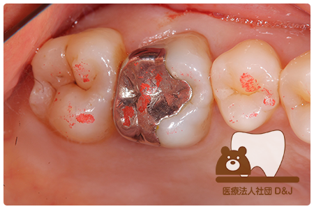 症例1 治療前の写真①