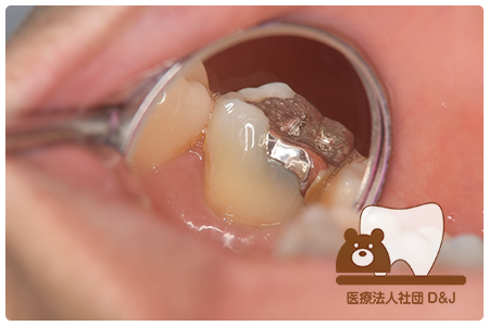 症例1 治療前の写真②