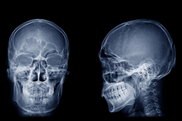 脳へのダメージを吸収のイメージ写真